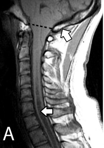 Chiari Malformation