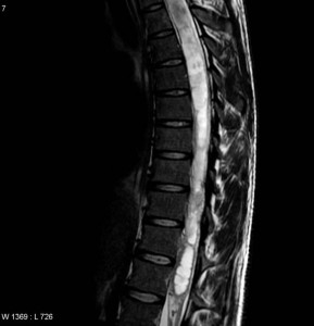 Thoracic Syringomyelia